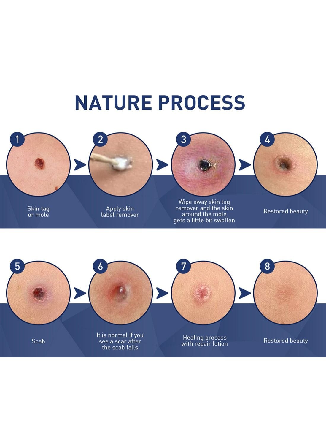 Herbal Skin Tag & Spot Corrector Liquid – Precision Care Serum Get Spot Corrector Precision Care Liquid For 1KD in Kuwait